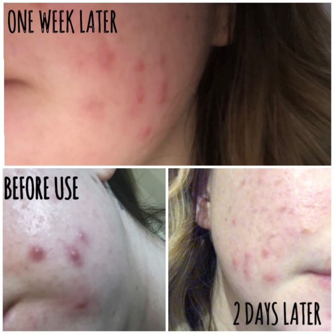 The Inkey List Beta Hydroxy Acid Before and After Pictures